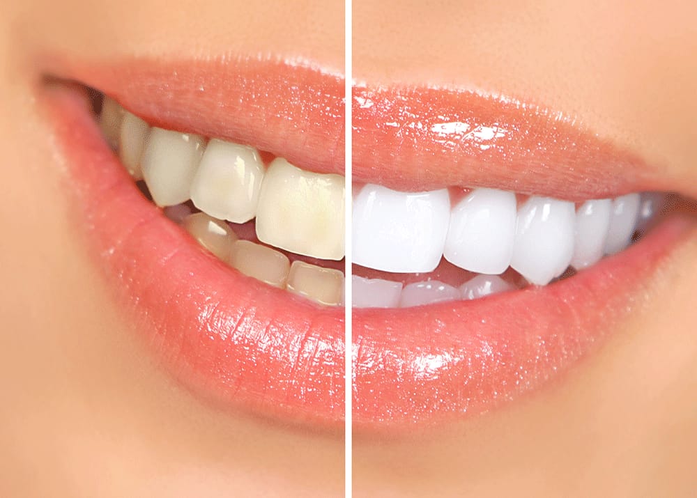 Smile shine:Teeth whitening powder