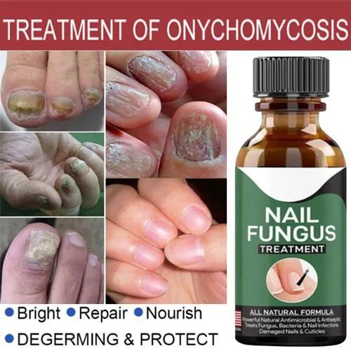 Fast Nail Fungal Treatments Foot Nail Fungus Removal Gel