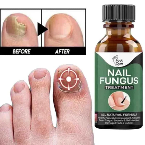 Fast Nail Fungal Treatments Foot Nail Fungus Removal Gel